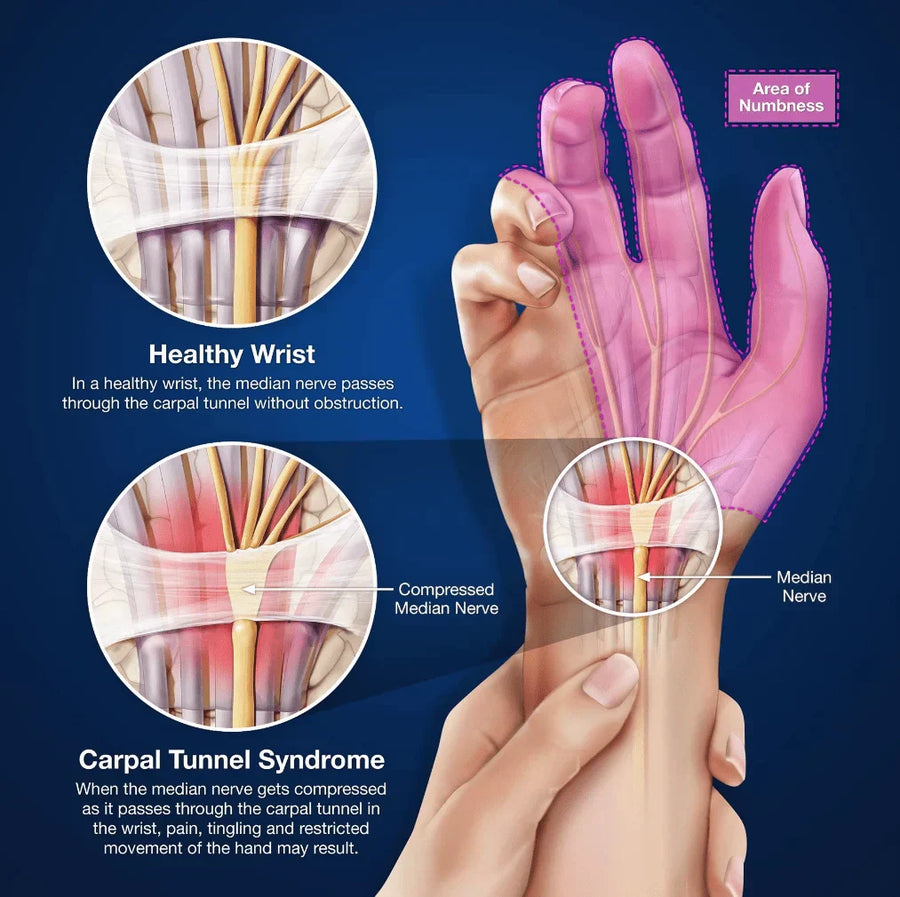 Red Light Therapy for Carpal Tunnel Syndrome