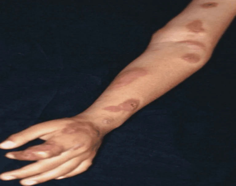 Sporotrichosis NIR Therapy Treatment: A Fungal Breakthrough