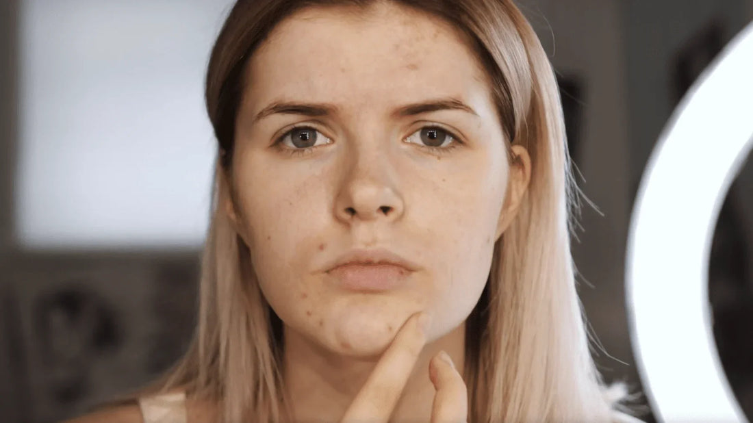 Red Light Therapy for Acne : A Revolutionary Treatment Backed by Clinical Studies