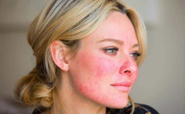 Red light therapy and rosacea
