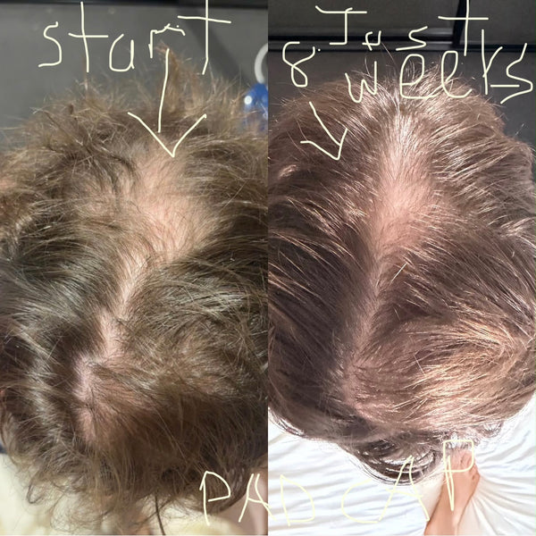 A side-by-side before-and-after comparison of a person's scalp, showing hair growth results after 8 weeks. The left side is labeled 'start' with a downward arrow pointing to thinner hair, and the right side is labeled 'just 8 weeks' with a downward arrow pointing to denser hair.